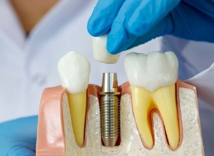 Things To Know Before Getting a Dental Implant Surgery?