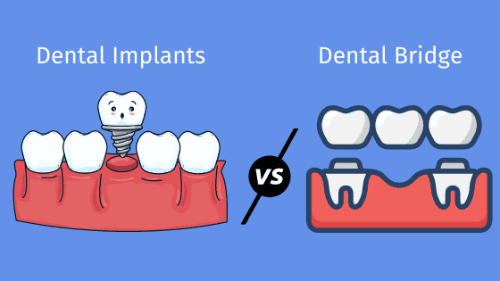 Dental Implants Vs Dental Bridge: What is the Difference?