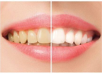5 Ways To Naturally Whiten Your Teeth At Home