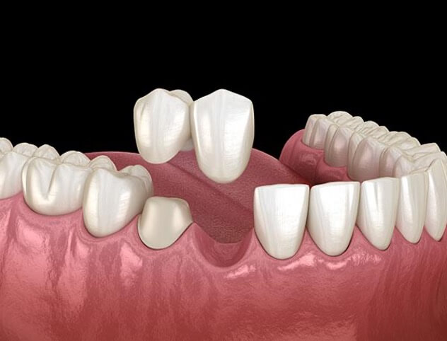 Cantilever Dental Bridge