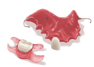 Flexible Partial Dentures