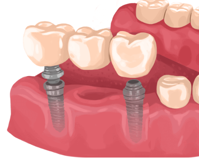 Implant-Supported Bridge