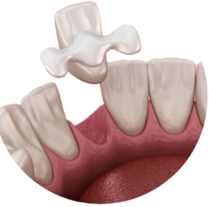 Maryland Dental Bridge
