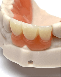 Metal Partial Dentures