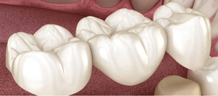Traditional Dental Bridge