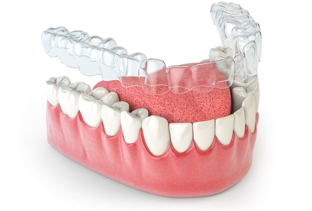 invisalign cost in Markham, ON