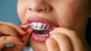 types of invisalign