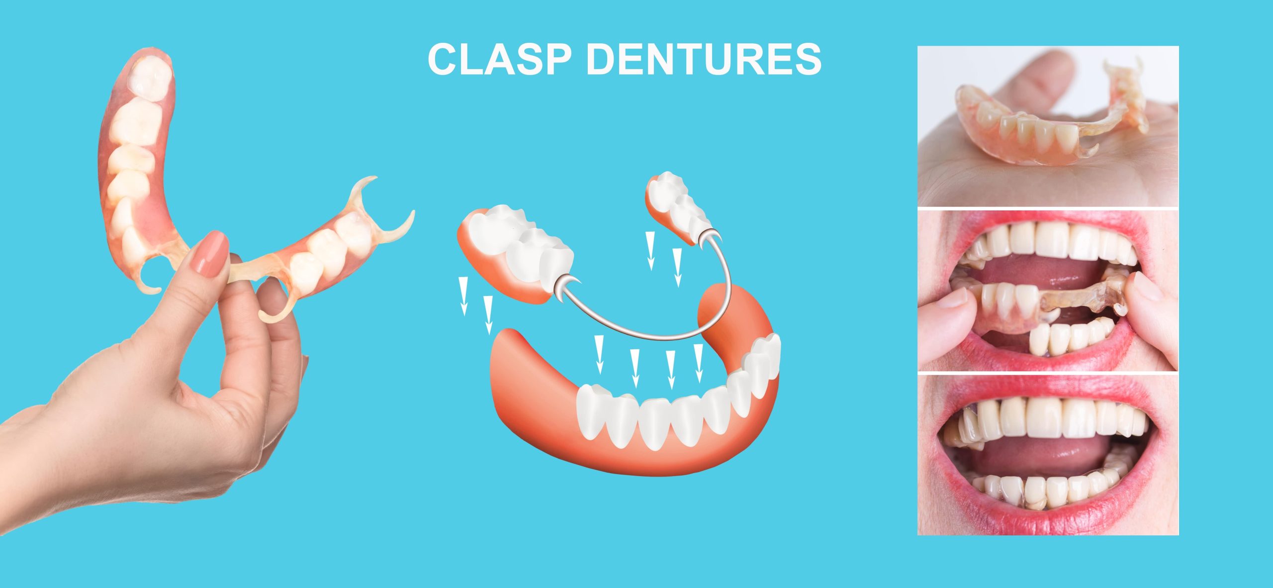 partial-dentures