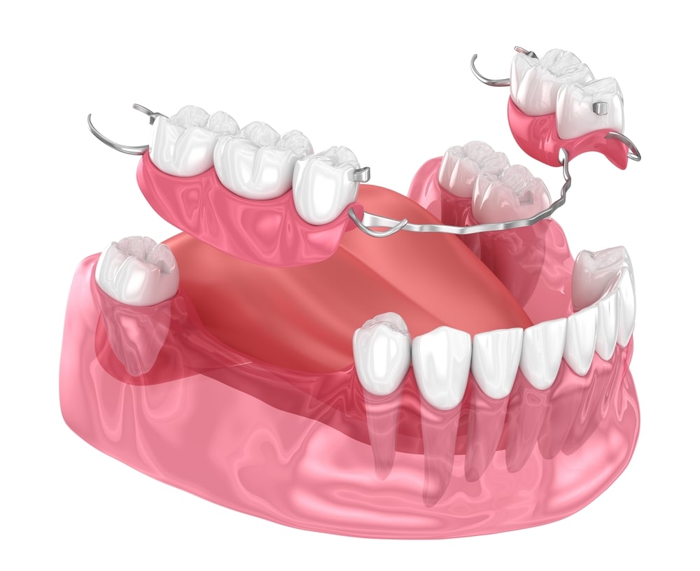 lower-denture