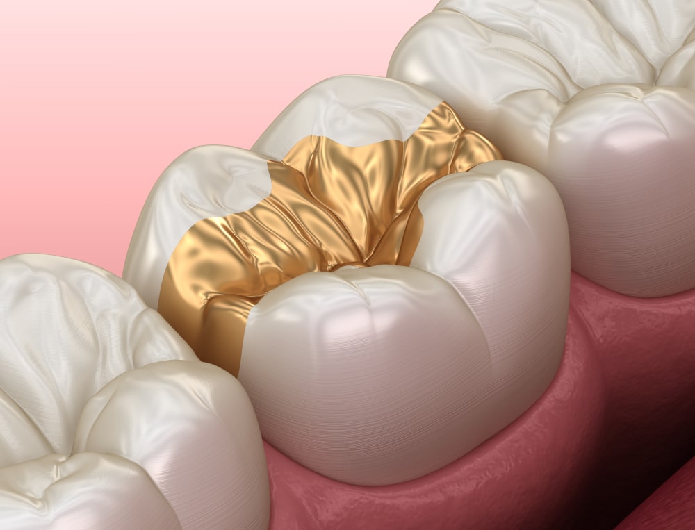 teeth-inlays-gold