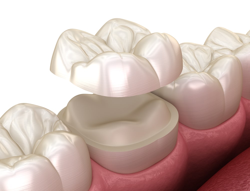 teeth-onlays