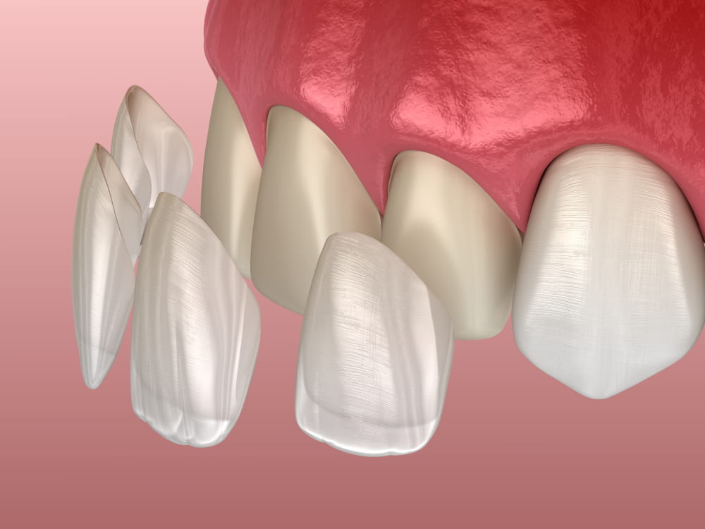 composite bonding teeth - Bur Oak Dental